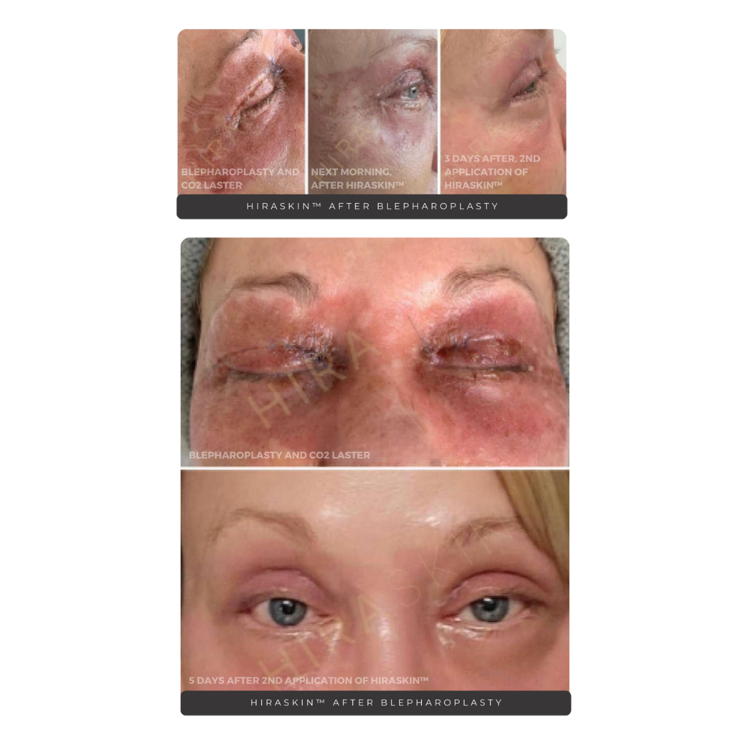 HIRASKIN™ Second Skin Collagen Masks (50)